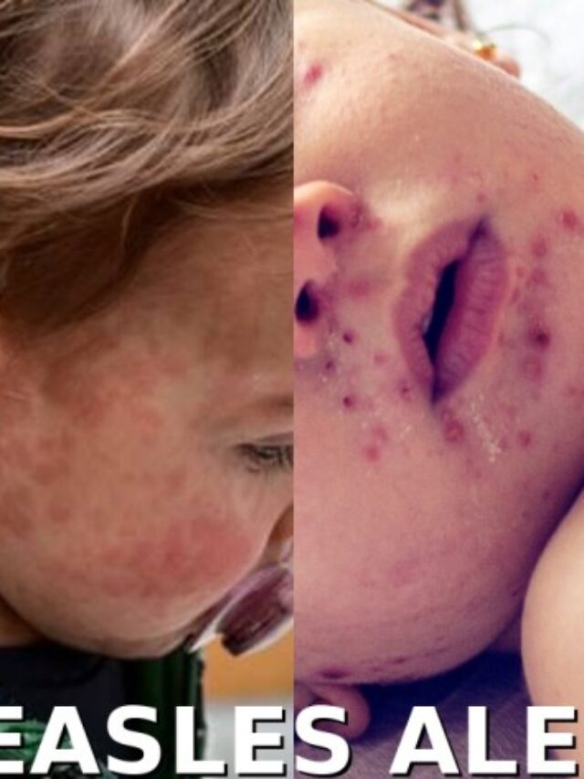 WHO Confirms New Recombinant Mpox Strain in India & UK (2026): Symptoms, Risk and Global Update